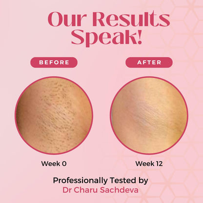 Effora's IPL Laser Hair Removal Handset for Face & Body | 6 Months Warranty